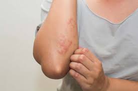 Skin Rashes: Causes, Prevention and Solutions